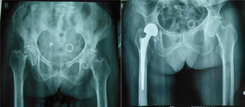 股骨颈骨折手术案例